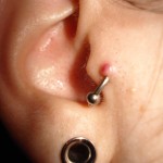 tragus-piercing-keloid