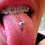 tongue-piercing-braces